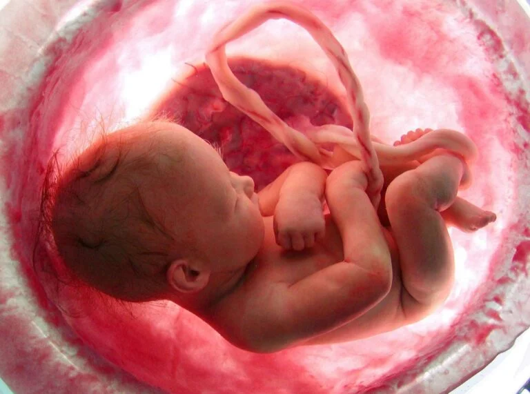 Hamilelikte Göbek Kordonu Sarkması