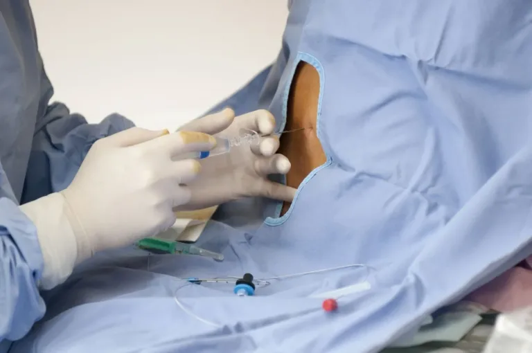 Accouchement sans douleur avec anesthésie péridurale