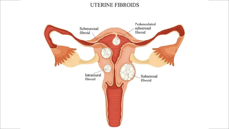 Fibromes utérins pendant la grossesse