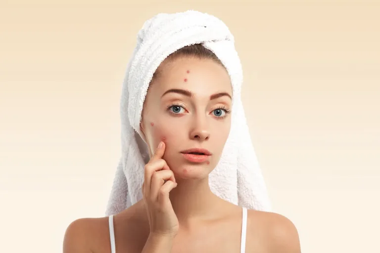 Formação de acne durante a gravidez