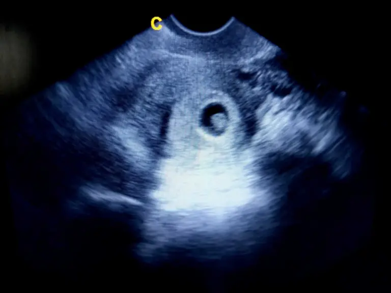 Taille du sac gastro-intestinal en fonction des semaines de grossesse