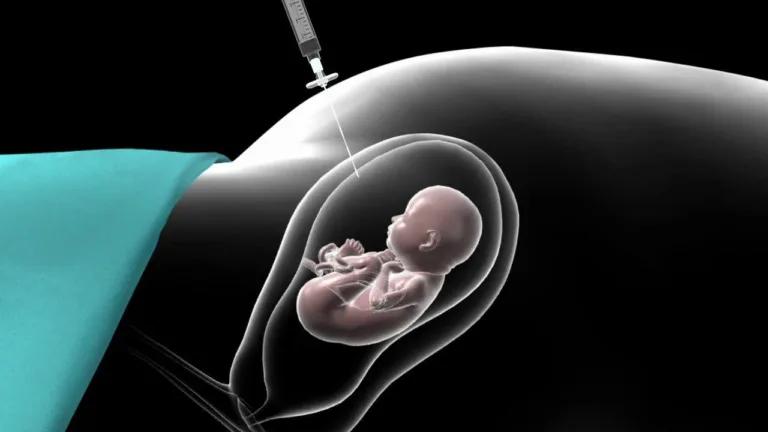 Amniyosentez Nedir? Nasıl Yapılır?